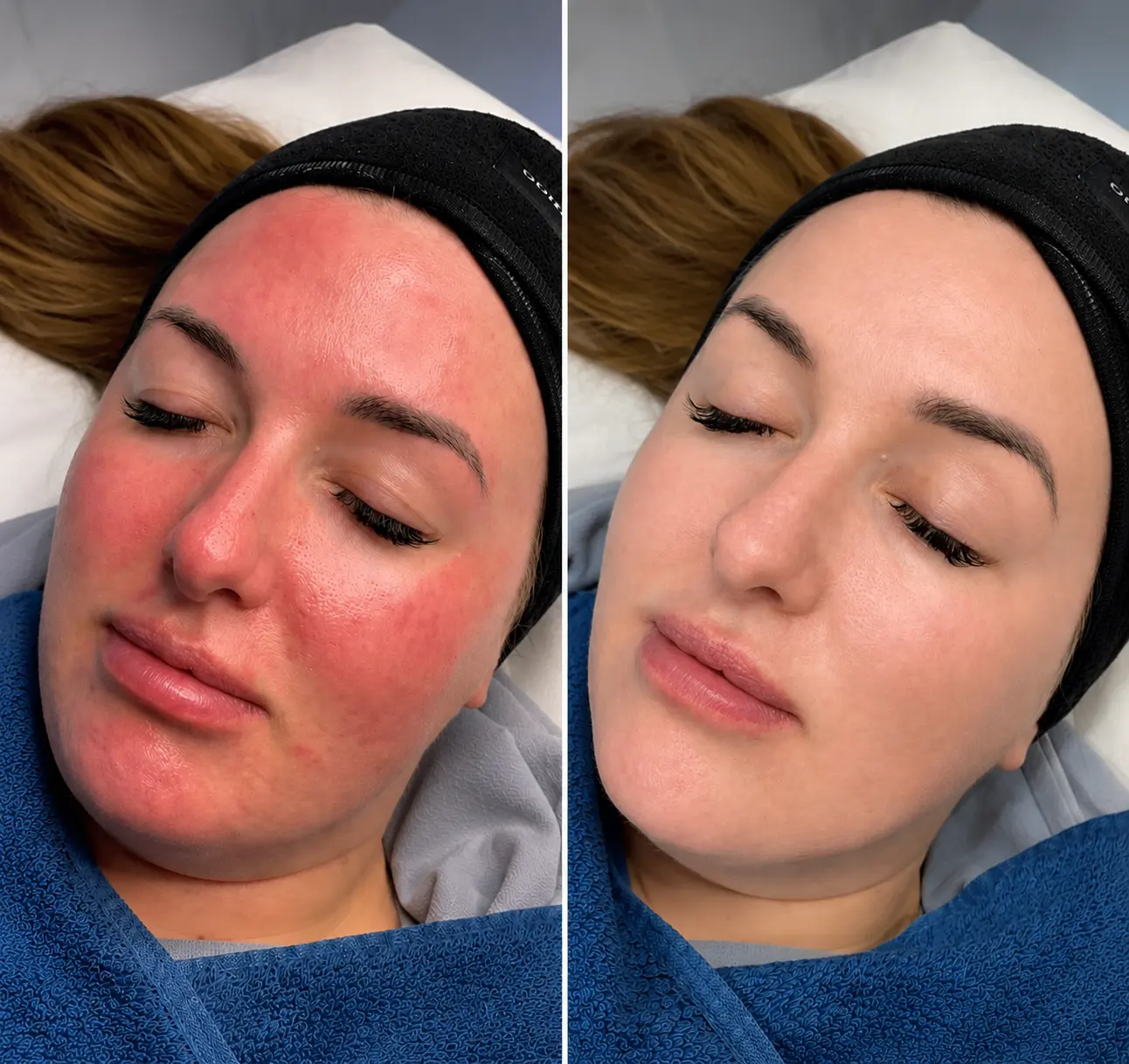 Facial redness reduction before and after Lumecca IPL treatment at Face Medical Aesthetics