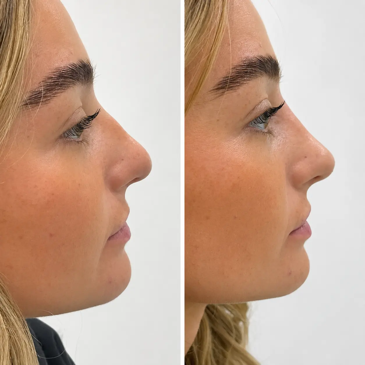 Non-surgical rhinoplasty before and after result at Face Medical Aesthetics