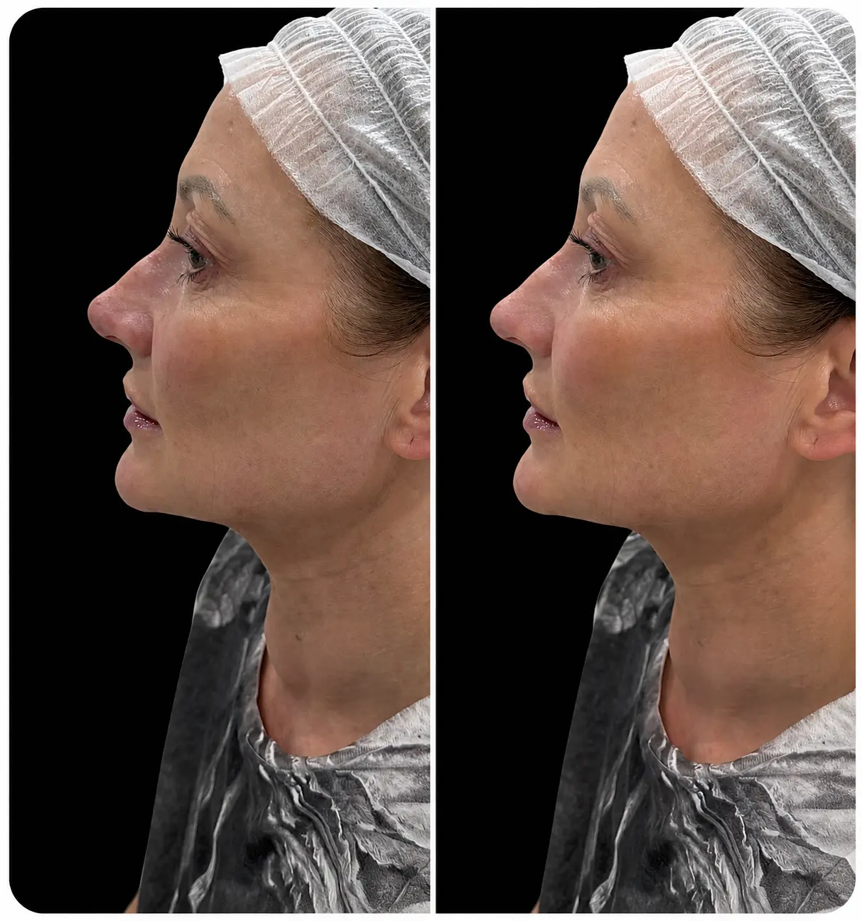 Non-surgical rhinoplasty before and after dermal filler treatment at Face Medical Aesthetics
