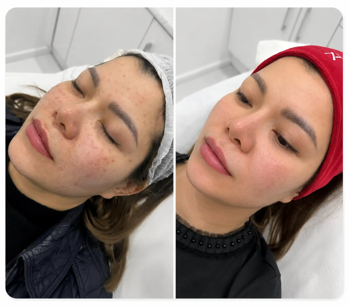 Skin booster complexion renewal before and after treatment at Face Medical Aesthetics