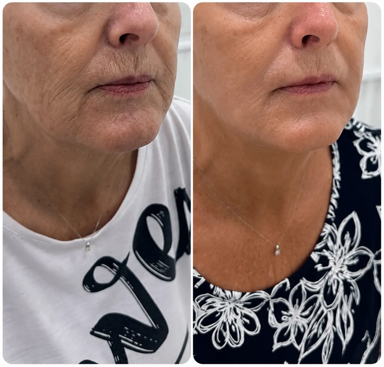 Skin quality and fine line improvement before and after treatment at Face Medical Aesthetics