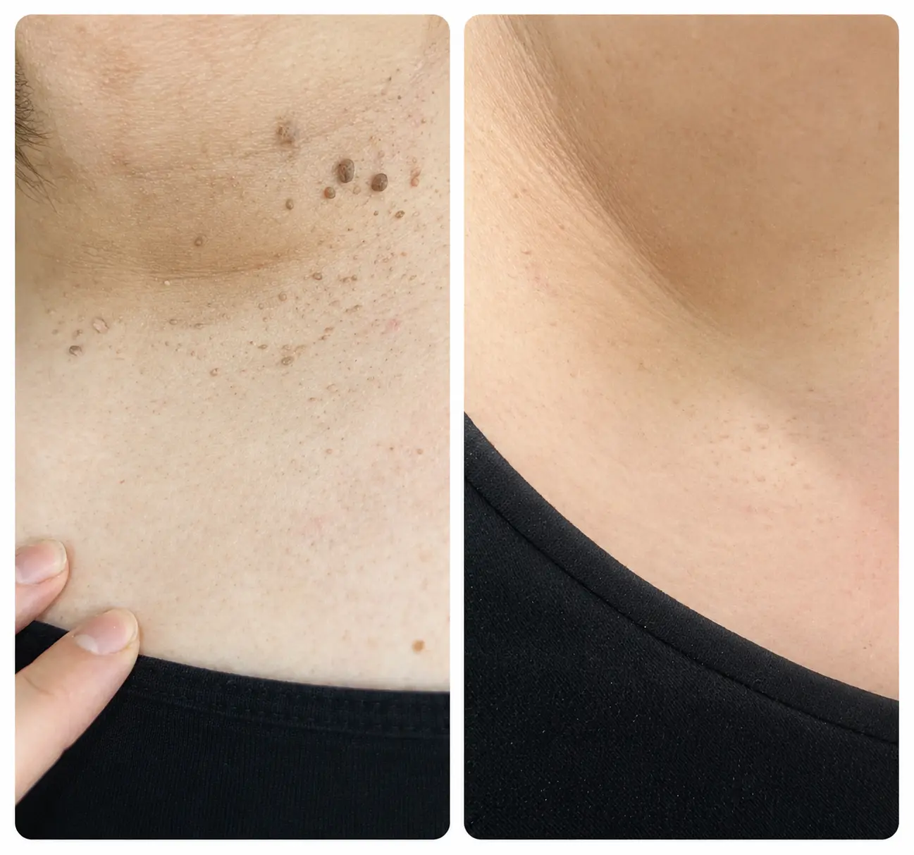 Skin tag removal before and after CryoPen treatment at Face Medical Aesthetics